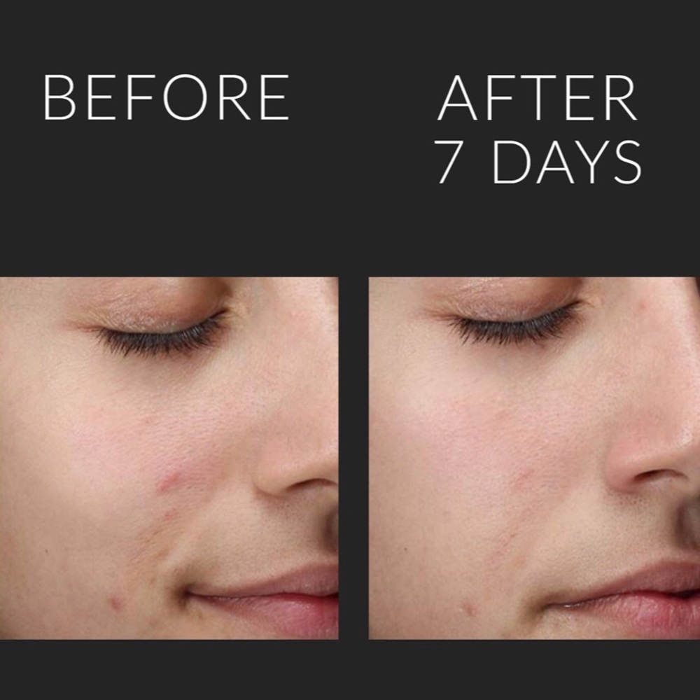 LIQUID EXFOLIKATE® Acid Resurfacing Treatment - Picture 10 of 13